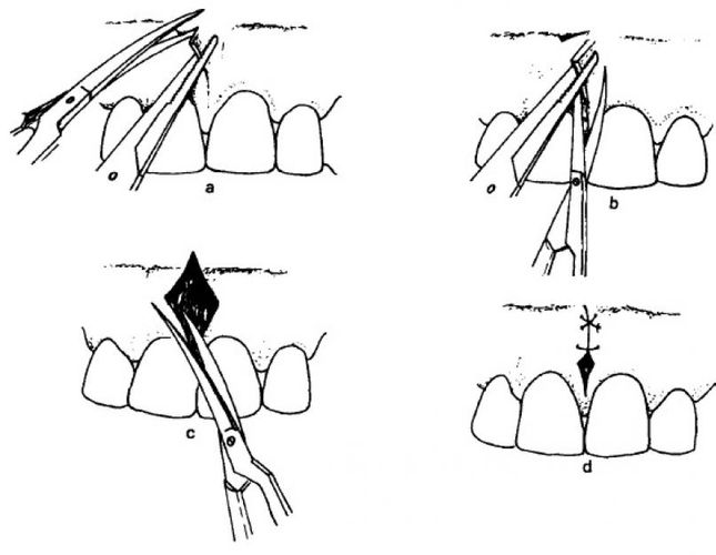 Схема пластики уздечки верхней губы