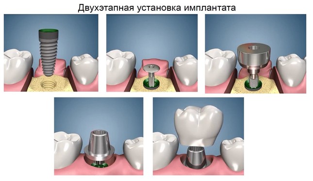 Схематический принцип двухэтапной имплантации зубов