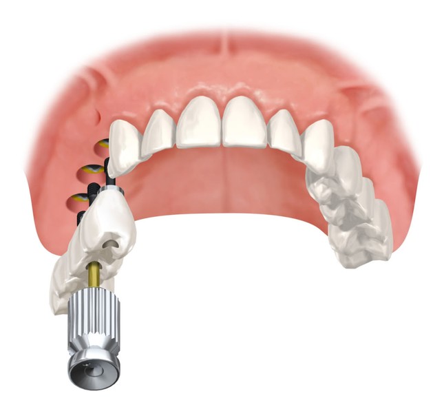 Принцип имплантации зубов верхней челюсти