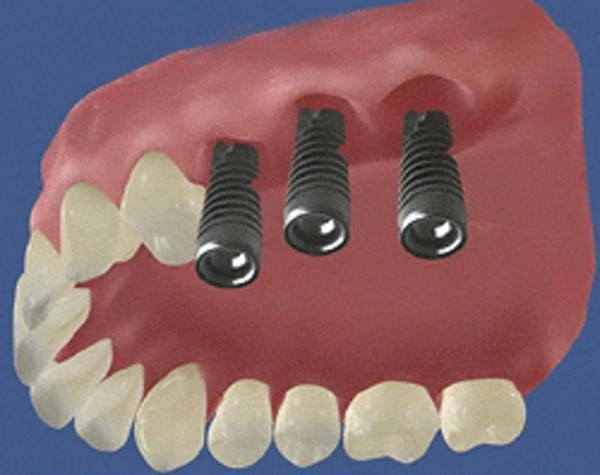 Имплантация жевательных зубов верхней челюсти