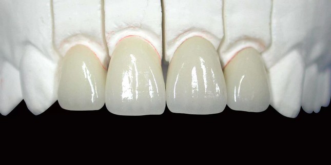 Циркониевые коронки с керамическим покрытием на передние зубы