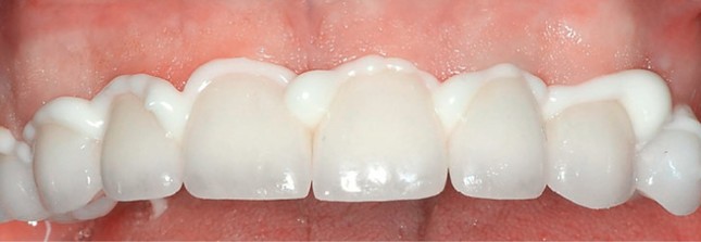 Установка на стоматологический цемент