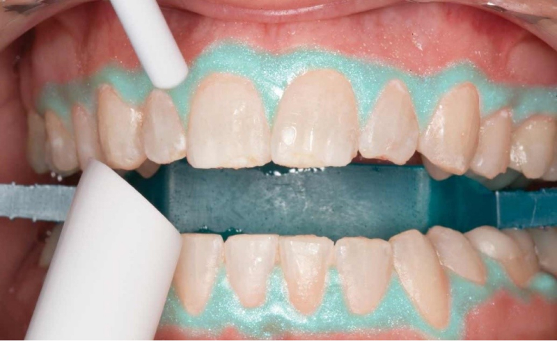 Этап гелевого фторирования зубов