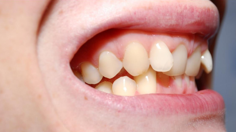 Рост зубов вне линии зубного ряда - показание для ортодонтического лечения