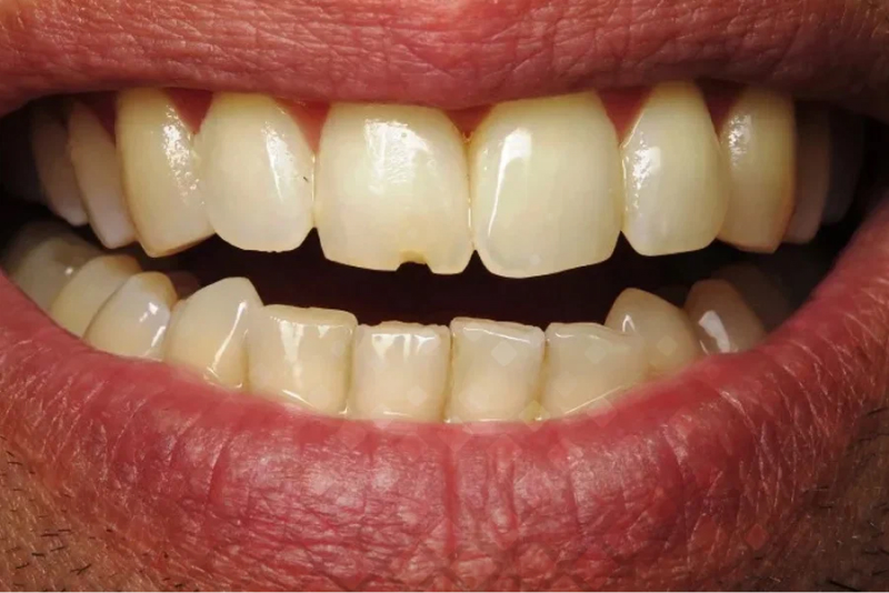 Сколы и&nbsp;волнистый край переднего зубного ряда&nbsp;&mdash; показание к&nbsp;реконструкции
