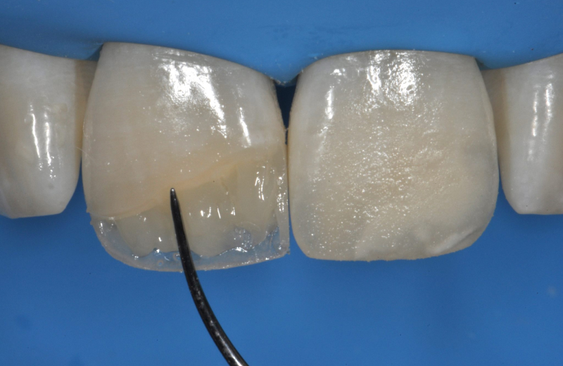 В процессе прямой реставрации зубов