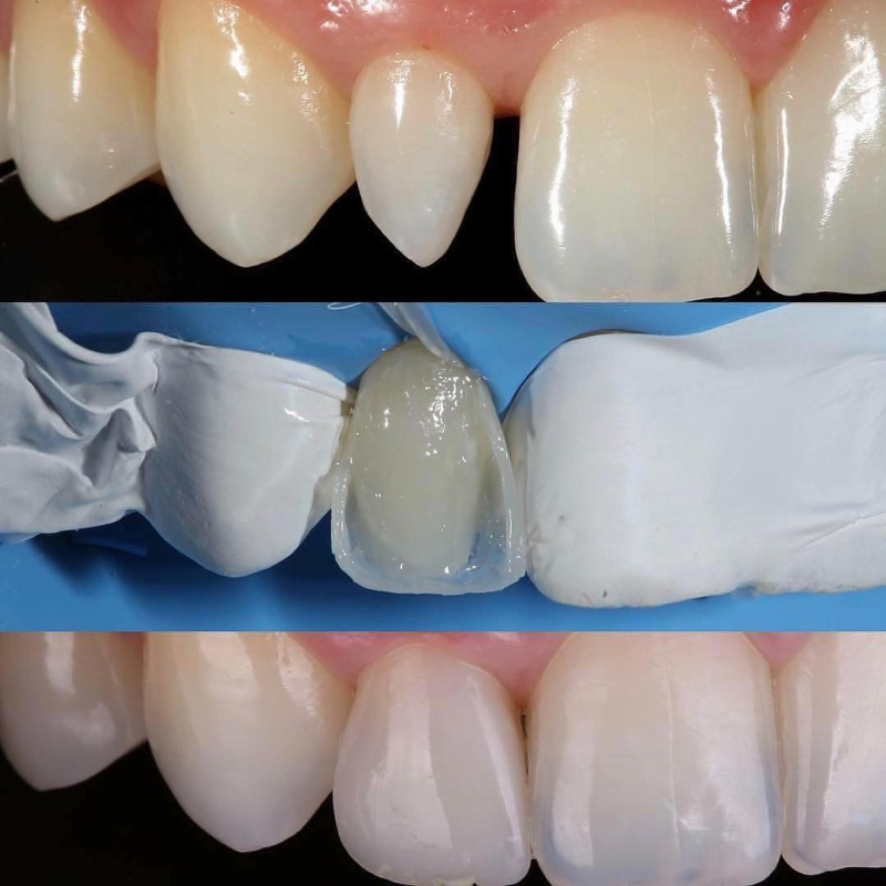 Разные этапы композитной реставрации зубов
