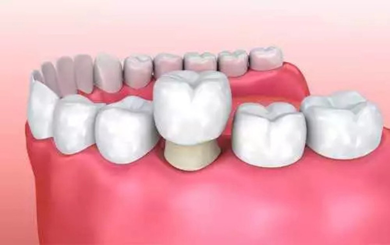 В процессе наращивания зубов коронками