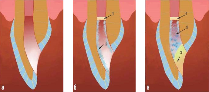 Этапы и суть внутриканального отбеливания зубов