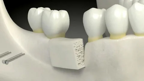 Принцип наращивания костной ткани зубов