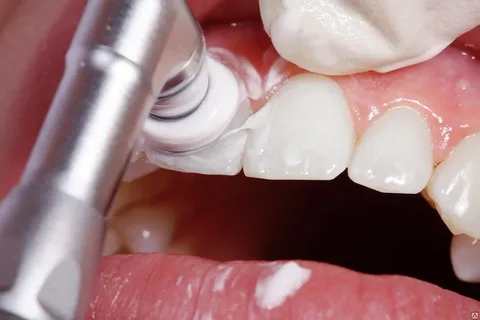 Процесс профессиональной чистки зубов
