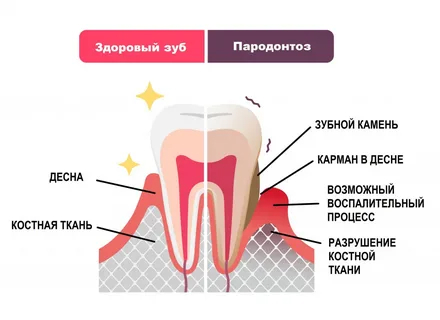 Сравнение здорового зуба и состояние при пародонтозе