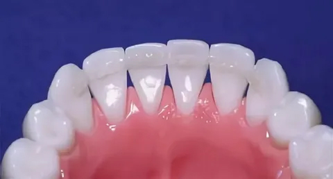 Принцип шинирования зубов