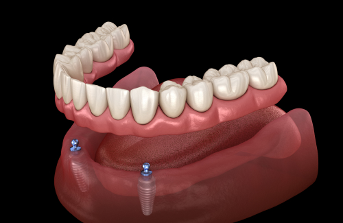 Правда о съемном протезировании в стоматологии