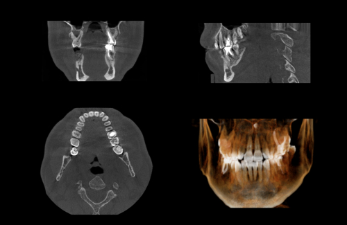 Трехмерное рентгенологическое исследование зубов - особенности услуги