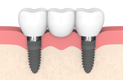 Зубные имплантаты и нанотрубки диоксида титана