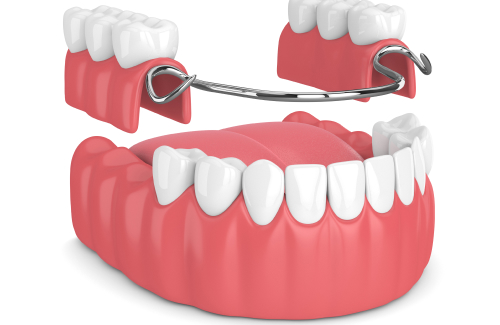История зубных имплантатов