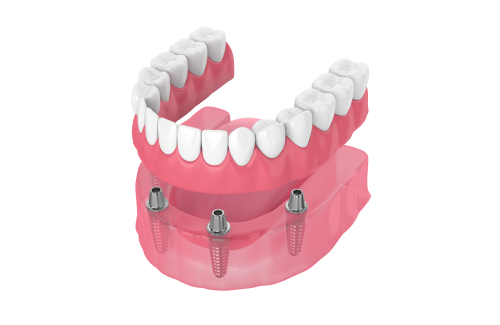 Фиксированные зубные протезы или имплантаты: вопрос рентабельности
