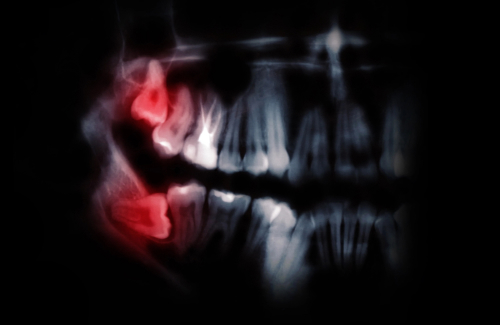 Удаление зуба мудрости: показания и осложнения 