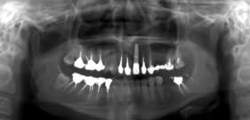 При помощи микроимпланта 37 зуб был выведен на прежнее место