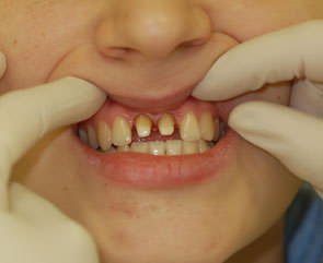 Пациентке произведена обработка 2-х зубов под коронки по причине значительного разрушения эмали