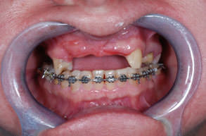В подготовительном периоде проводилось ортодонтическое лечение, ввиду смещения зубов