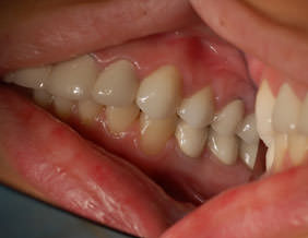 В процессе лечения остальные зубы были перелечены и подготовлены под протезирование