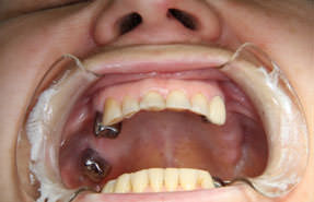 Отсутствие зубов верхней челюсти