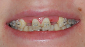 У пациентки врожденно отсутствовали 1.2 и 2.2 зубы