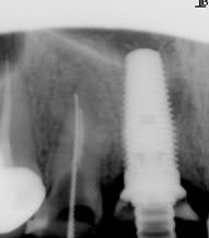 21 зуб был удален с одномоментной установкой импланта Nobel Replace и временной коронкой