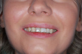 Зубы восстановленные из пломбы с анкерным штифтом