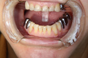 Пациентка обратилась к нам с жалобами на сильную стираемость резцов, по причине отсутствия жевательных зубов