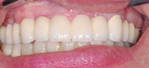 Циркониевые мостовидные протезы Nobel Procera фиксированные на имплантах и боковых зубах слева
