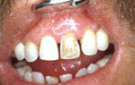 Понятие реставрации зуба показания противопоказания