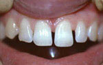 Реставрация в стоматологии противопоказания