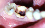 Противопоказания к реставрации зубов