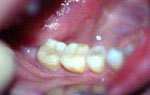 Реставрация в стоматологии противопоказания thumbnail