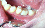 Реставрация зубов показания противопоказания thumbnail