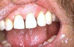 Противопоказания к реставрации зубов абсолютные и относительные thumbnail