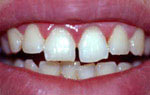 Эстетическая реставрация зубов показания противопоказания