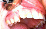 Противопоказания для реставрации зубов