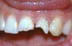 Понятие реставрации зуба показания противопоказания