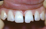 Реставрация в стоматологии противопоказания