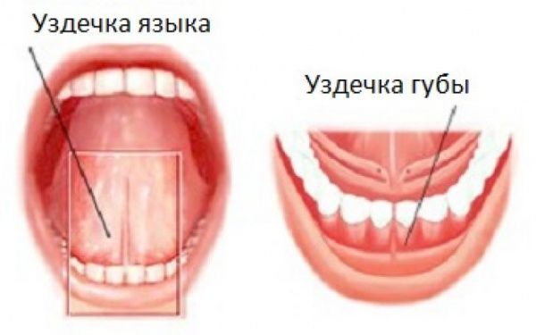 Пластика уздечек языка и верхней губы