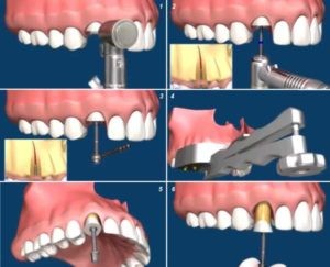 Сложные случаи удаления коренного зуба