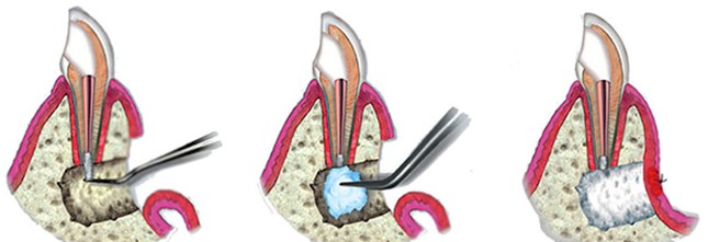 Цистэктомия корня зуба