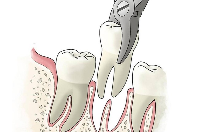 Принцип простого удаления зуба