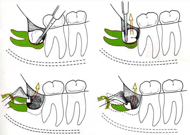 Принцип сложного удаления зуба