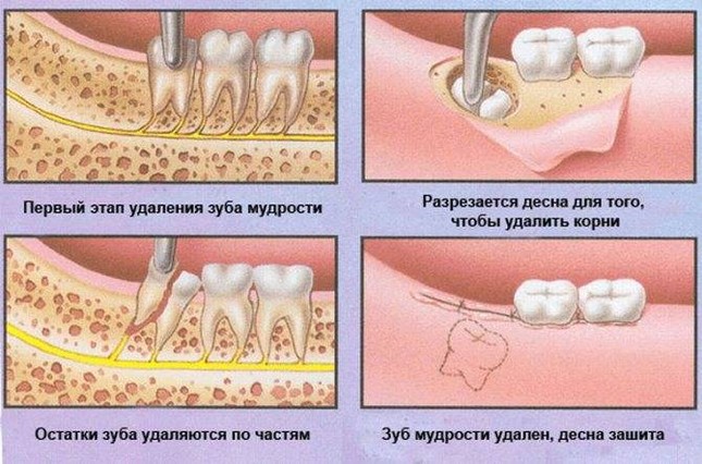 Процесс удаления ретинированного зуба