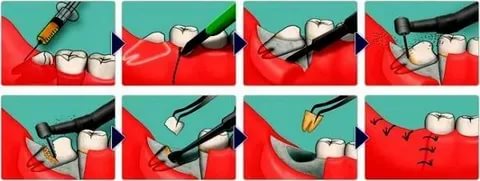 Инфографика удаления сложного зуба